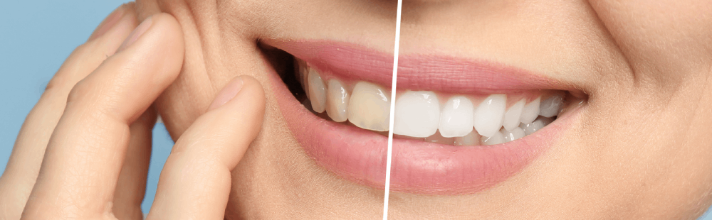 Teeth Whitening in Marietta